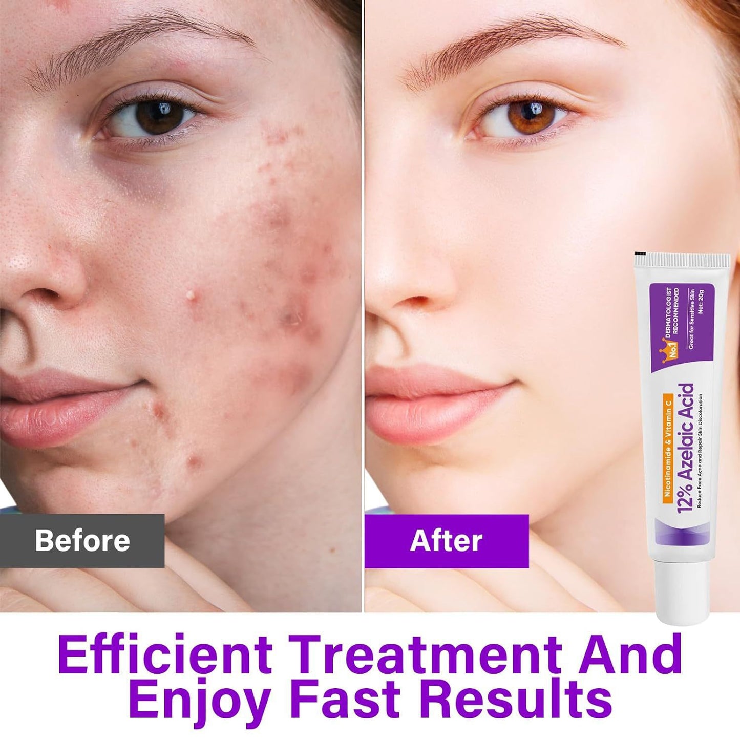 Azelaic Acid Gel, Cosmetics / Skincare / Personal Care